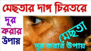 মেছতা দূর করার উপায় | ঘরোয়া পদ্ধতি